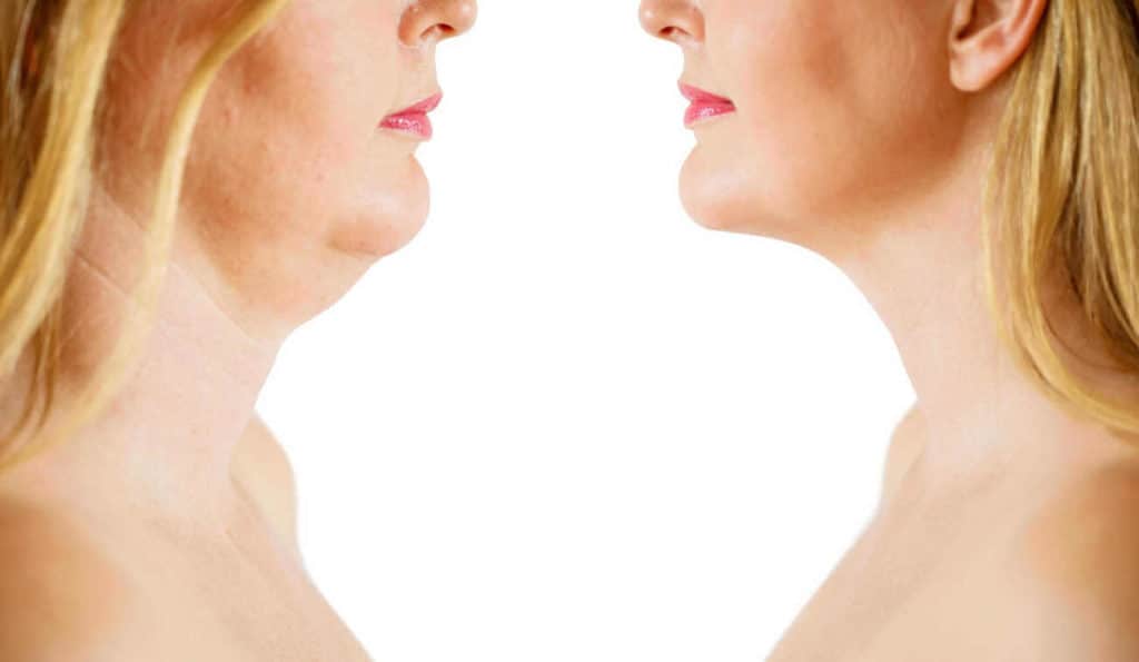 Double Chin treatment Romsey before and after results