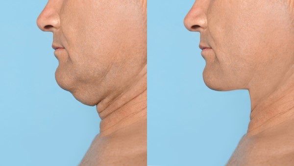 Which Non-Surgical Treatments Work Best for Jowls and Loose Skin Romsey?