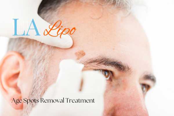 What Are the Most Effective Treatments for Age Spots Romsey?