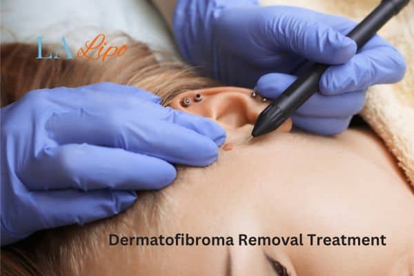 Dermatofibroma Removal Treatment Romsey