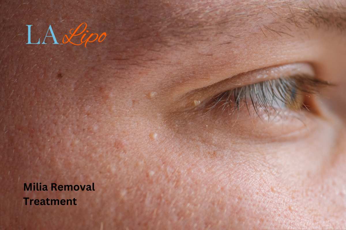 Cryopen Milia Removal: Is It the Easiest and Safest Option Romsey?