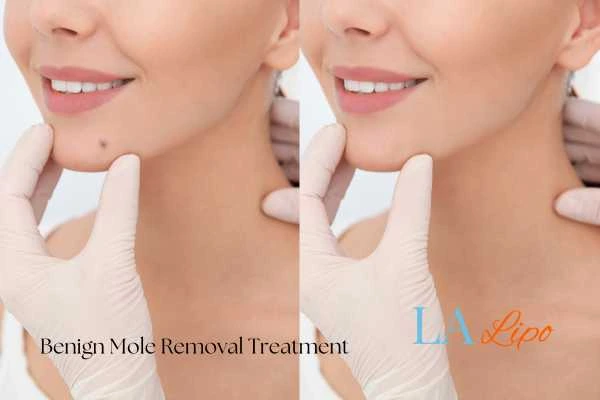 Before-and-after results following benign mole-removal treatment Romsey