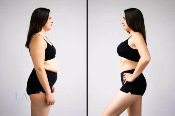 image of woman before and after results of LA-EMS Body Sculpting Romsey to help treat Diastasis recti