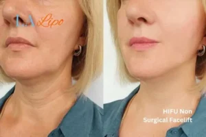 hi-fu for wrinkles Romsey before and after results