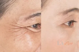 Before and after results of woman - HI-fu wrinkles reduction treatment Romsey