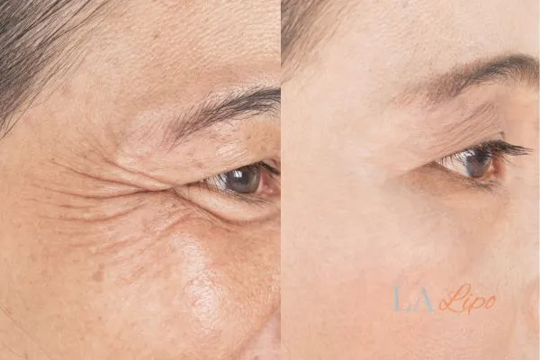 Before and after results of woman - HI-fu wrinkles reduction treatment Romsey