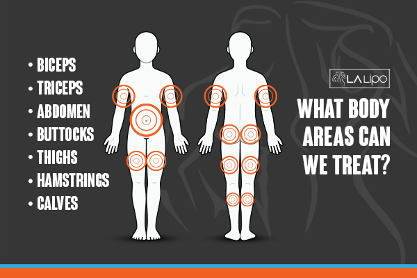Graphic to show areas you can have LA-EMS Body Sculpting Romsey treatment.