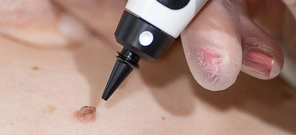 skin tag removal using cryopen Romsey