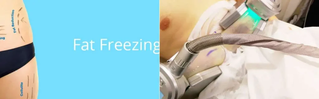 Fat freezing Romsey on multiple areas of the body