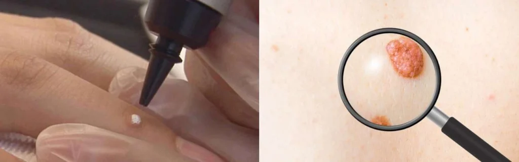CryoPen practitioner Romsey assessing a benign mole before treatment