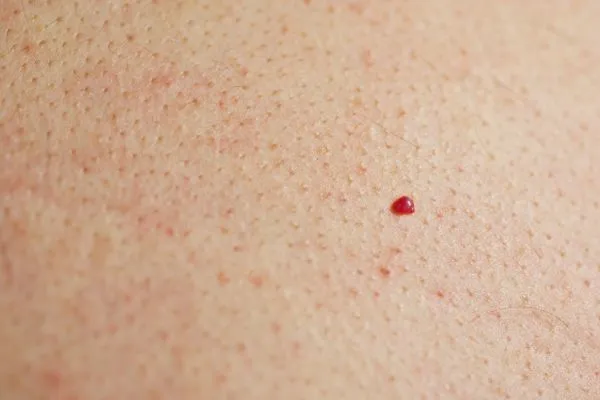 close up of a cherry angioma Romsey