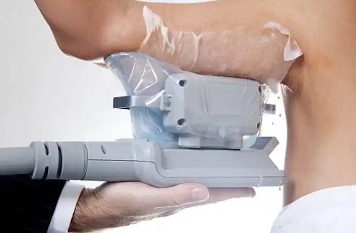 Picture of fat freezing Romsey on the upper arms.