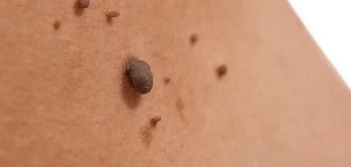 image of a skin tag Romsey