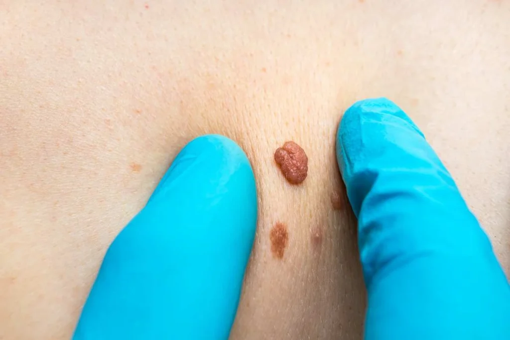 Consultant examining a skin tag Romsey