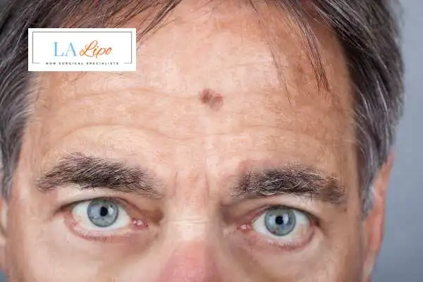 Solar Lentigo Removal Romsey image of man with mark on his forehead