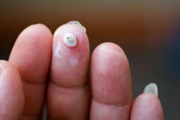 wart on person finger - cryotherapy to treat from LA LIPO Romsey