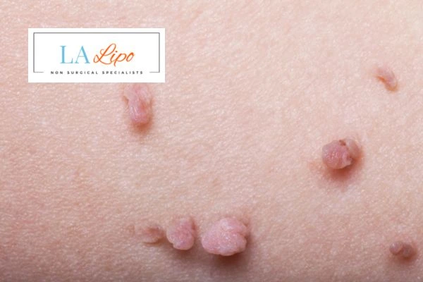 Does cryopen skin tag removal Romsey hurt? Find out now call our team today!