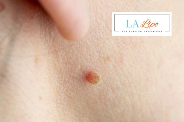 Book skin tag removal Romsey today speak to our team now!