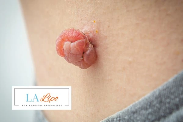 Interested in skin tag removal Romsey? Concerned about the pain? Find out more today!