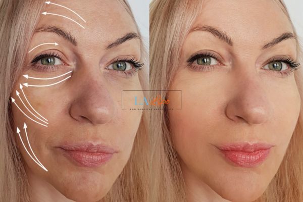 Morpheus 8 results Romsey face lift.