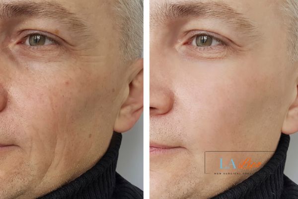 See the amazing results of Morpheus8 Treatment Romsey!