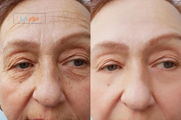 The powerful benefits of Morpheus8 Treatment Romsey - Call Our team today!
