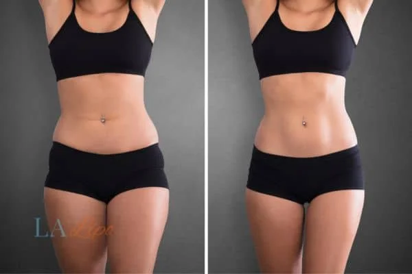 before and after results of non-surgical treatment to help a woman's body image and mental health Romsey