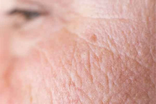 close up picture of a woman's face showing an age spot Romsey