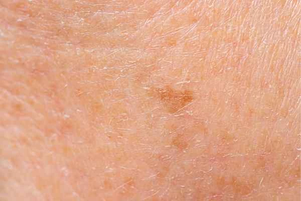close up picture of age spots Romsey