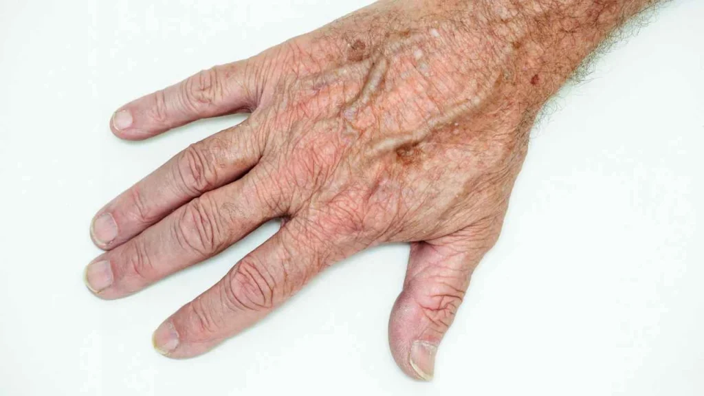 Male hand showing age spot Romsey