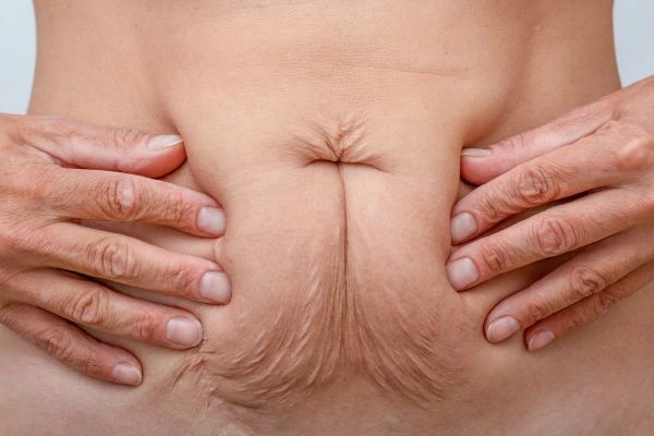 Image of a woman's stomach with loose skin - example of skin tightening Romsey options