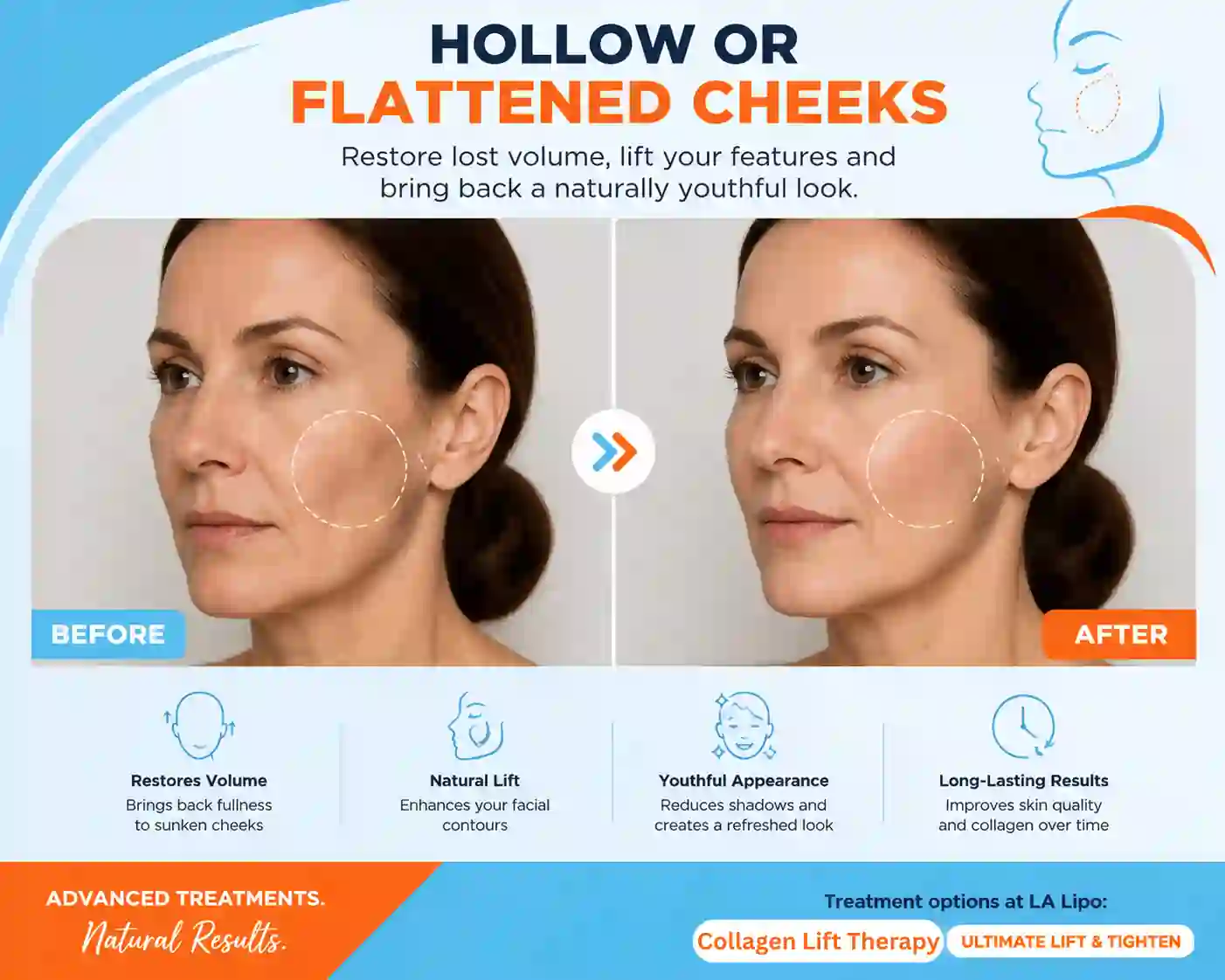 Sign #4: Hollow or Flattened Cheeks Romsey