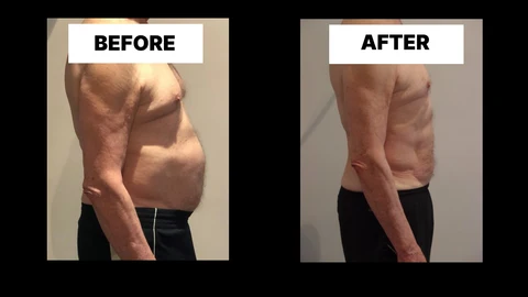 What Symptoms Can Diastasis Recti Cause in Men? Weak Core, Back Pain and Poor Posture Romsey
